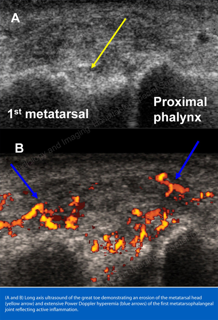 Long axis ultrasound image of the great toe demonstrating an erosion of the metatarsal head (yellow arrow) and extensive Power Doppler hyperemia (blue arrows) of the first metatarsophalangeal joint reflecting active inflammation.