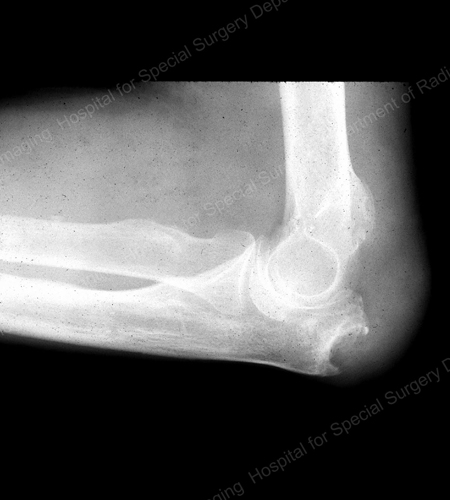 X-ray of gouty erosion at the proximal ulna at the elbow