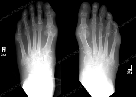 X-ray of gout at the base of the 1st toe