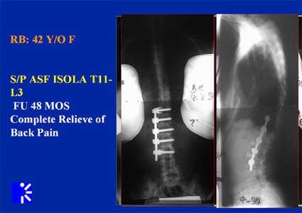 Managing Scoliosis & Stenosis With Low Lumbar Degeneration