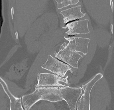 CT scan used to assess bony elements of spine