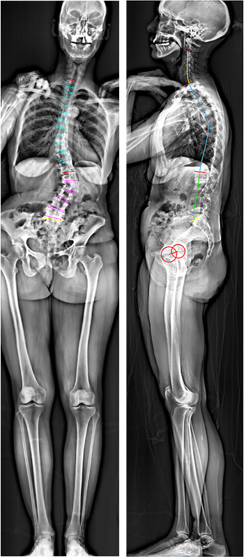 X-rays of adult spinal deformity before and after surgery