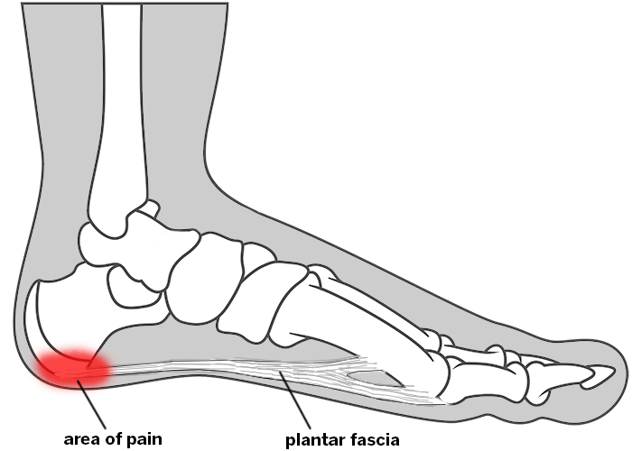 Foot, showing location of pain for plantar fasciitis