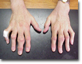 Photo of multiple tophi in the hands of a patient with long-standing gout.