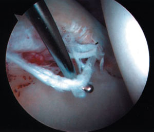 image of a torn labrum at the rim of socket from an article about hip arthroscopy