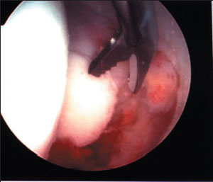 image of the removal of loose body from inside the hip from an article about hip arthroscopy
