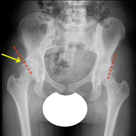 normal xray of the hip