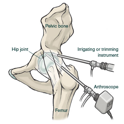 intra articular hip injection technique