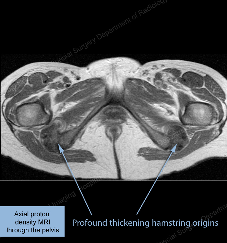 What's the Diagnosis - Case 12 Image 12 - HSS