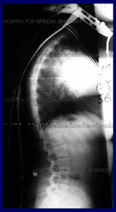 Image: Radiograph of a patient wearing brace demonstrating correction