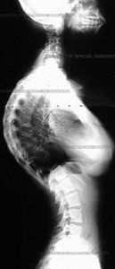 Immagine: Le radiografie di una ragazza di 14 anni con cifosi di Scherermann di 85 gradi che ha subito una fusione spinale con strumentazione che corregge la sua colonna vertebrale a 36 gradi.