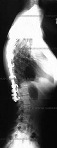 Image: As radiografias de uma menina de 14 anos com Kyphosis de Scherermann medindo 85 graus, que foi submetida a uma fusão vertebral com instrumentação corrigindo a coluna vertebral para 36 graus.