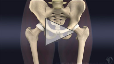 Animation: PAO for hip dysplasia in adolescents and young adults