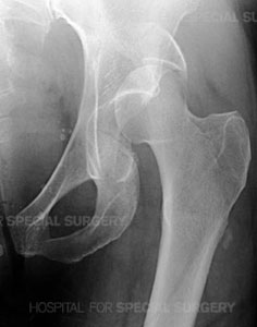 cracked pelvis in elderly