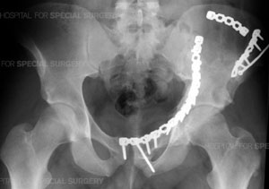 Radiograph of a pelvis following ORIF from an article about Pelvic Fractures/Acetabular Fractures