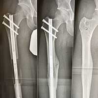 Bone Growth Stimulation  Florida Orthopaedic Institute