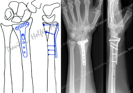 preoperative plan and radiographs at 6 months reveal a healed distal radius fracture from a case example presented by the orthopedic trauma service at Hospital for Special Surgery.