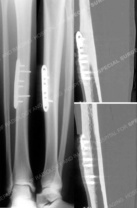 stress fracture in shin treatment