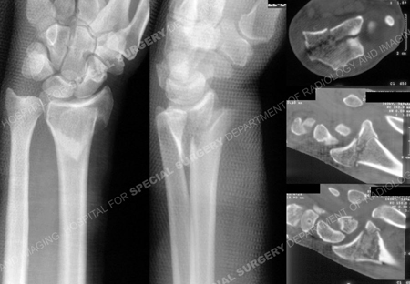 radiographs and ct scans revealing distal radius fracture from a case example presented by the orthopedic trauma service at Hospital for Special Surgery.