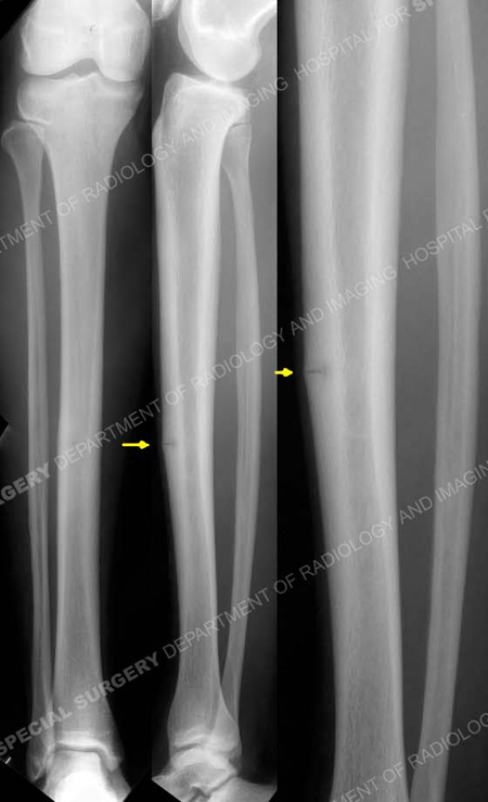 stress fracture in shin treatment