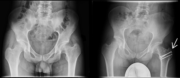 Periacetabular Osteotomy: An Overview - HSS