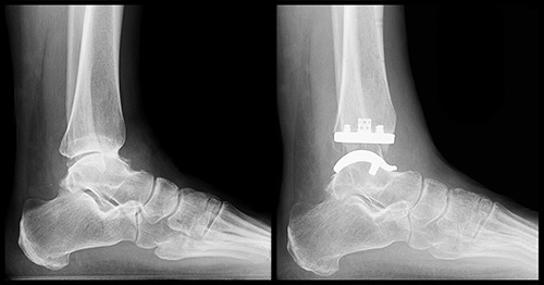 Ankle Replacement Surgery How It Works Recovery Time HSS
