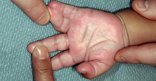 Small hands with short and thin digits.