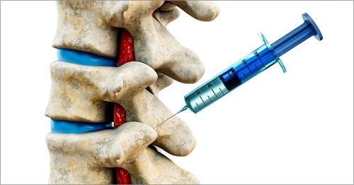 A 3D illustration of a facet joint injection.