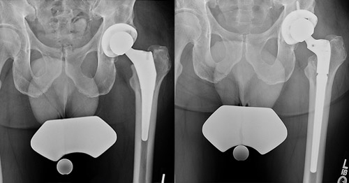 X-ray images of hip revision before and after.