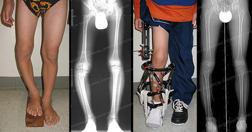 JCM | Free Full-Text | Measuring Recovery and Understanding Long-Term  Deficits in Balance, Ankle Mobility and Hip Strength in People after an  Open Reduction and Internal Fixation of Bimalleolar Fracture and Their