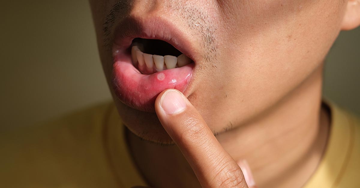 curing acid bumps on tongue