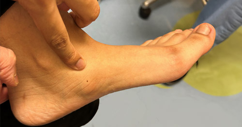 Accessory Navicular: Congenital Foot Deformity & Treatments