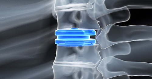 Cervical And Lumbar Disc Replacement Surgery Hss Spine