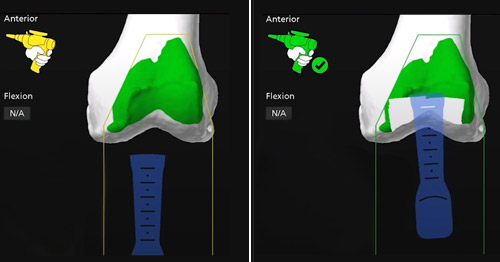 Computer image navigation during a robotic knee replacement.