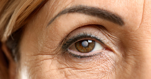 Close-up of a woman's eye presenting with a cataract.