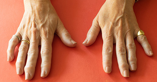 Arthritis and Grip: How Arthritis Affects Grip, How to Strengthen Grip