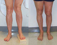 Before and After Images of Limb Lengthening from Hospital for Special Surgery