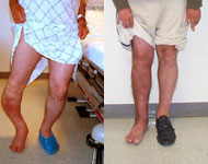 Before and After Images of Deformity Correction from Hospital for Special Surgery